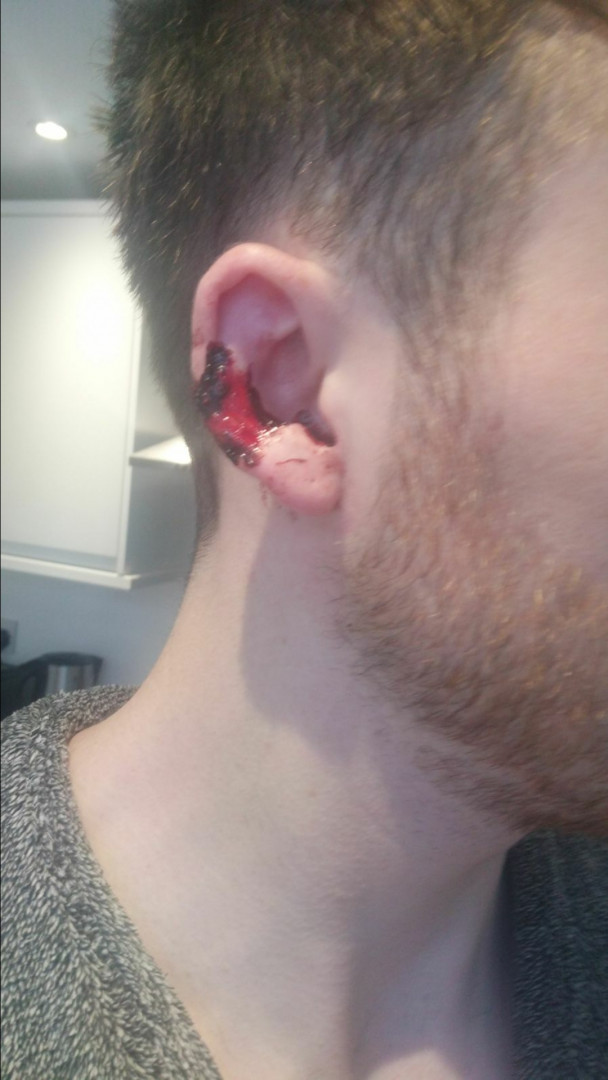 Appeal after man’s ear bitten – London