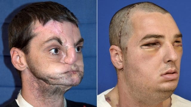 US face transplant gives man new jaw, teeth and tongue